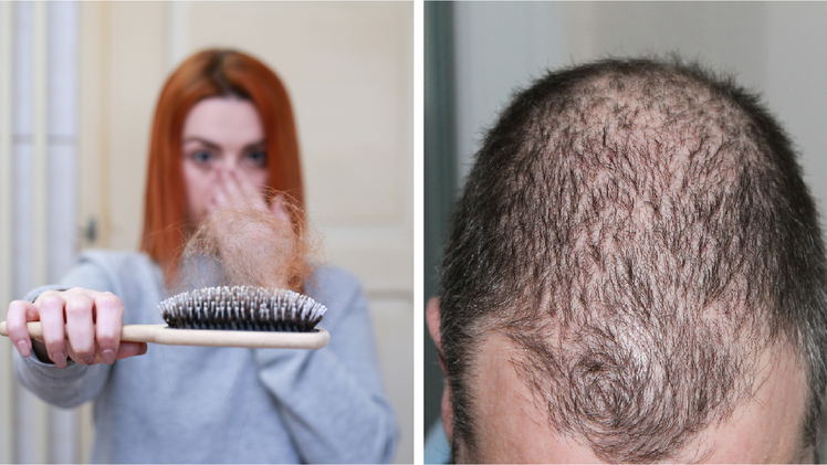 Haarausfall: Erlanger Forschern gelingt Durchbruch – Wirkstoff zeigt keine Nebenwirkungen
