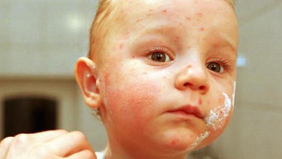 Der rote Ausschlag ist charakteristisch: Deshalb können Windpocken ganz leicht diagnostiziert werden. Foto: epd