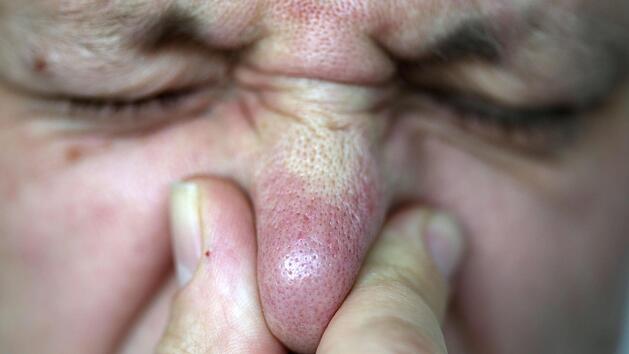 Nasenbiss vor der Hauptb&uuml;hne: Im Streit um den richtigen Zeitpunkt eines Pogo-Tanzes kam es beim Taubertal-Festival  zum Gerangel zwischen zwei jungen M&auml;nnern. Hierbei biss ein 27-J&auml;hriger seinem 20-j&auml;hrigen Kontrahenten einen Teil der Nase ab. Symbolfoto: Oliver Berg/dpa