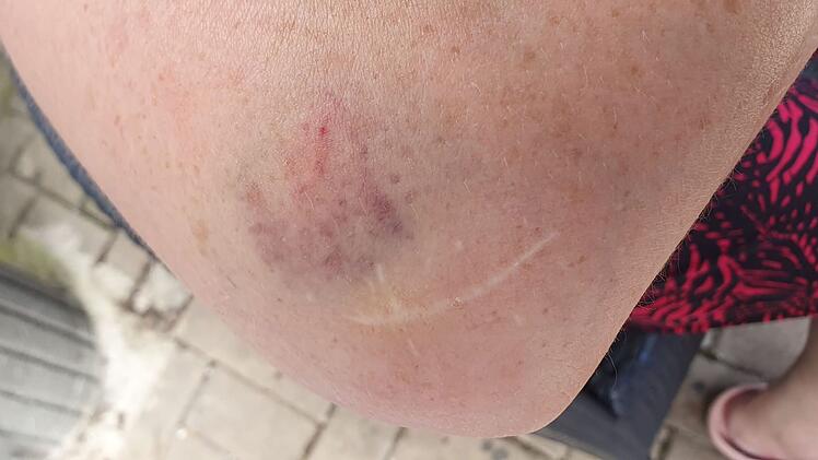 Neustadt bei Coburg: Mitarbeiterin schildert wilde Beißattacke durch Ladendiebin - "kaum zu bändigen"