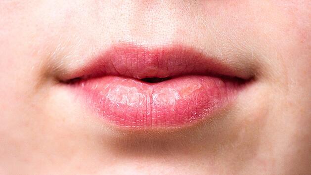 Eingerissene Lippen können schnell zu einer langwierigen, schmerzhaften Geschichte werden.