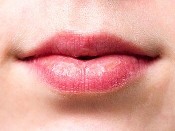 Hast du einen roten Ausschlag rund um die Lippen, kann es an perioraler Dermatitis liegen.
