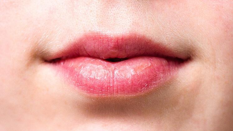 Hast du einen roten Ausschlag rund um die Lippen, kann es an perioraler Dermatitis liegen.