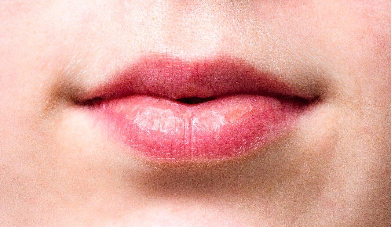 Roter Rand Um Die Lippen