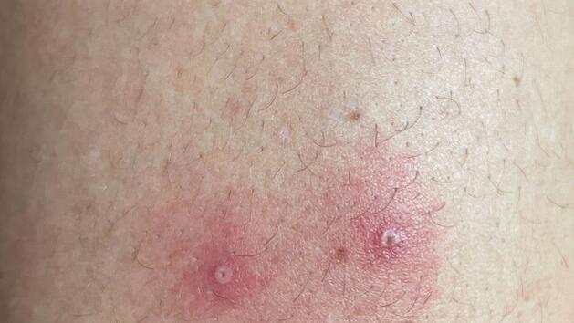 "Tomatengrippe" in Indien ausgebrochen