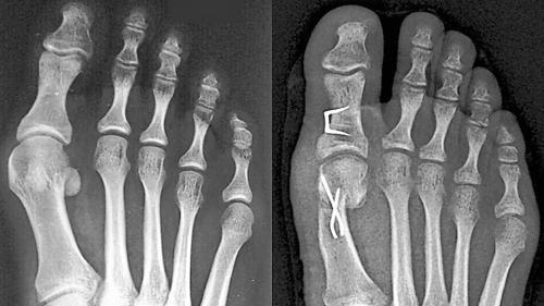 Ein Hallux Valgus kann unter Umständen ohne OP behandelt werden.
