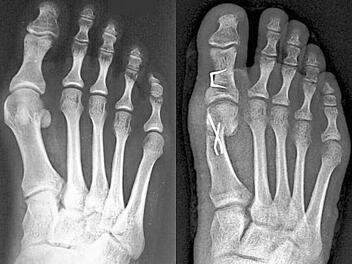 Ein Hallux Valgus kann unter Umständen ohne OP behandelt werden.