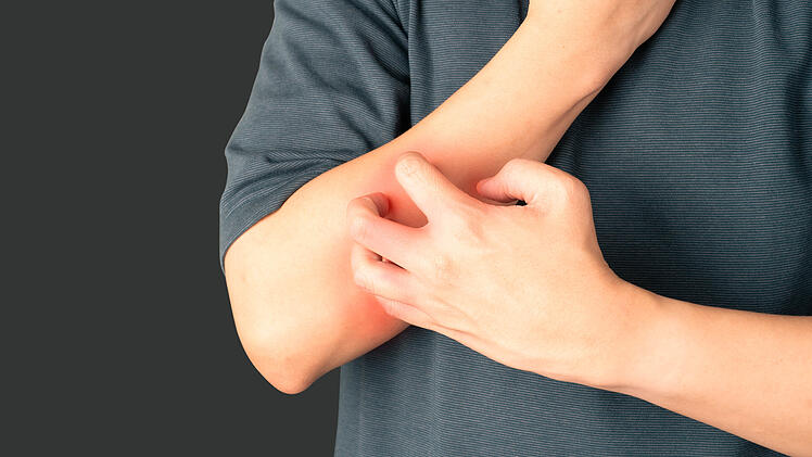 Man scratching arm from having itching over dark background. Cause of itchy skin include  eczema, atopic dermatitis, psoriasis, food or drugs allergies and dry skin. Health care concept.