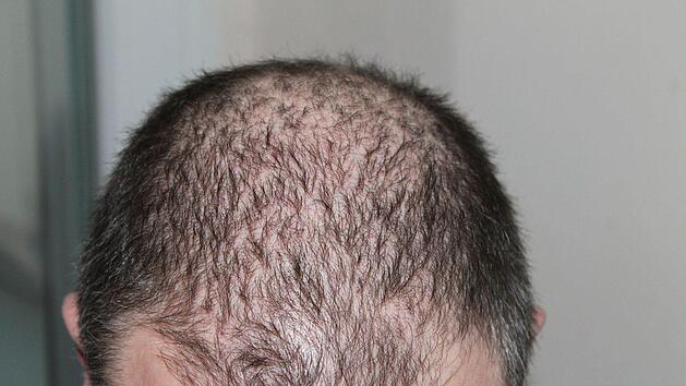 Amerikanische Forscher haben eine neue und einzigartige Methode entwickelt, Haarausfall zu bek&auml;mpfen. Symbolbild: pixabay.com/kalhh