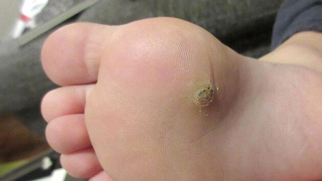 Verursacht durch Viren sind Warzen h&auml;ufig schmerzhaft. Wie man sich vor sch&uuml;tzen kann - und warum man sie niemals Aufkratzen sollte.  Foto: Anja Garms/dpa