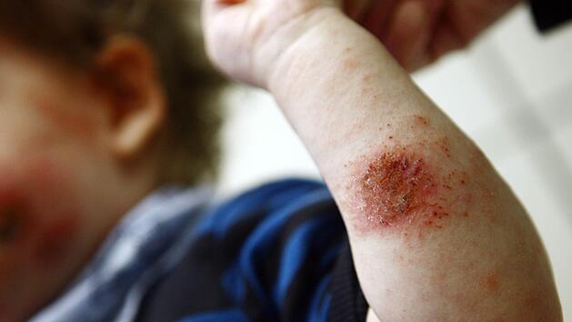 Neurodermitis ist für Betroffene die reinste Qual. Gerötete Stellen und lästiges Jucken sind typisch für die Krankheit. Foto: Oliver Berg/dpa