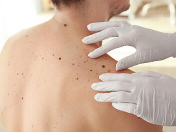 Dermatologe bei der Untersuchung eines Patienten in der Klinik, Dermatoskopie, Prävention von Melanomen, Hautkrebs.
